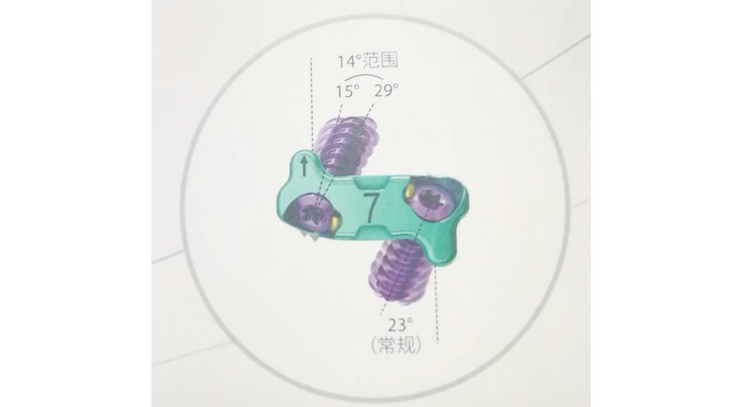 Zero Profile Cervical Interbody Fusion Cage